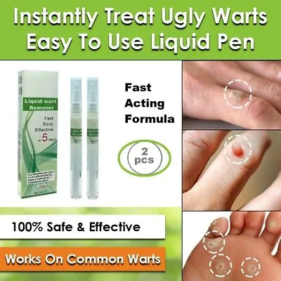 Wart Removal Pen. Natural Treatment For Warts Moles & Verucca Cream • £14.95