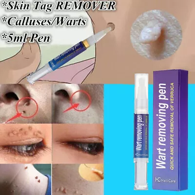 12 Hours Wart Remover Pen Skin Tag Mole Remover Eliminate Foot Corn Warts Unisex • $8.58