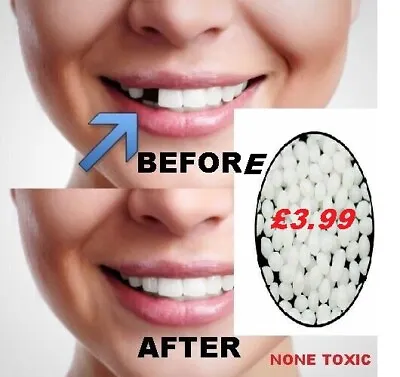 Temporary Tooth Repair Kit Fix Broken Teeth And Fills Gaps Non Toxic FREE P&P • £3.99