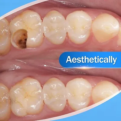 Dental Cement Teeth Resin Tooth Repair Gap Cavity Filling Strong Tooth Repair • £11.64