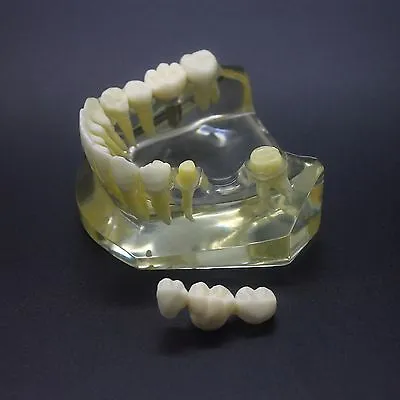 Dental 1:1 Lower Jaw Crown Bridge Implant Study  Model 2010 • $28.01