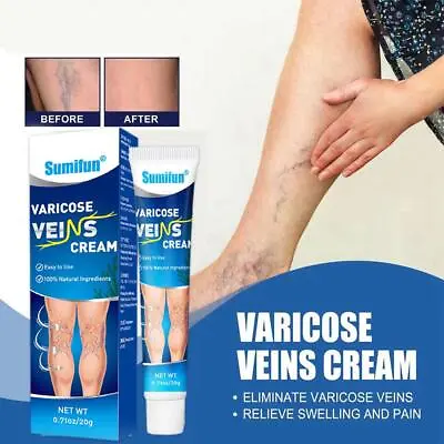 20g Treatment Legs Varicose Veins Cream Vein Care Fading Cream Herbal Ointment • £2.28