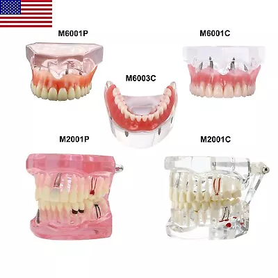 $39.09 • Buy US Dental Implant Disease Teeth Model Overdenture Implants Upper/Lower Demo 