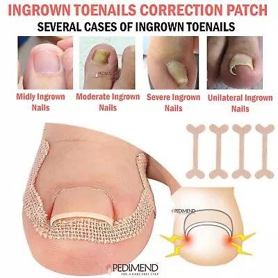 PEDIMEND Painless Ingrown Toenail Treatment - Toenail Corrector Patch- Foot Care • £10.99