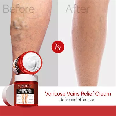 Varicose Veins Cream Treatment Ointment Removal Vasculitis Spider Veins Cream • £9.39