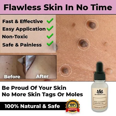 Organic Tags Solutions Painless Skin Tag Remover Mole Wart Remove Unwanted Flaws • $14.90