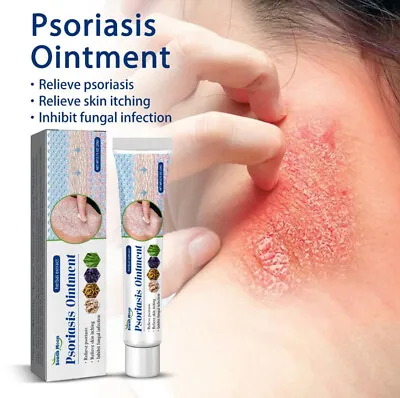 Psoriasis Eczema Dermatitis Natural Cream Skin Treatment Care Tube Ointment Pack • $23.99