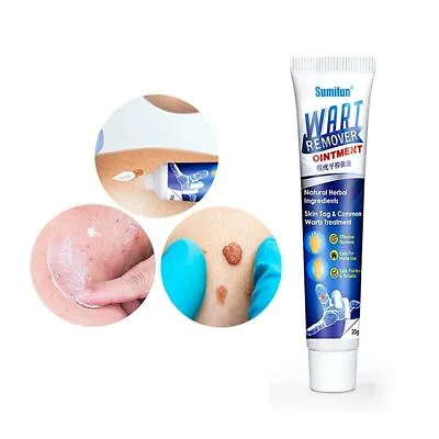 Warts Remover Cream Body Skin Face Warts Treatment Ointment 100g FREE SHIPPING • £28.50