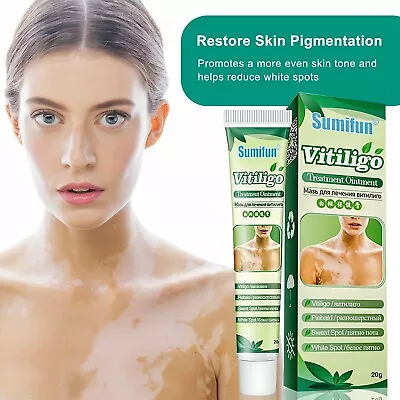 Sumifun Vitiligo Care Cream Good For Skin Vitiligo Leukoplakia Reduce Spots • $20.49