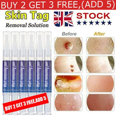 Wart Remover Pen Skin Tag Removal Treatment Cream Face Care Mole Corn Natural • £6.45