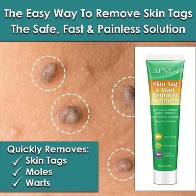 New Fast Skin Tag Remover Liquid Cream Natural Treatment Moles Warts & Tags • £12.50