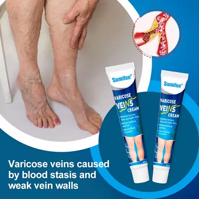 Varicose Veins Treatment Cream Vasculitis Phlebitis Spider Cream Removal Plas Sn • £3.65