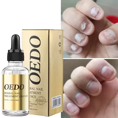 Fungal Nail Treatment Essential Oil Hand And Foot Nail Fungus Removal Oil • $13.89