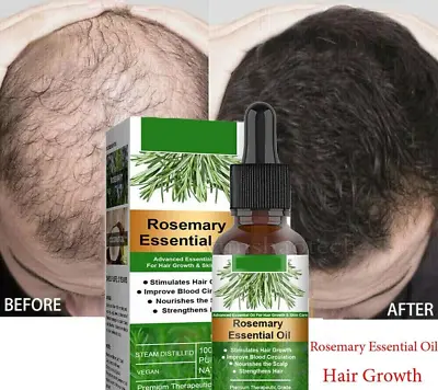 100% Rosemary Essential Oil Stimulates Hair Growth Skin Care Nourishes Treatment • £7.29