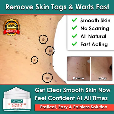 New Vova Skin Tag Remover Cream Natural Treatment Moles Warts  • £11.95