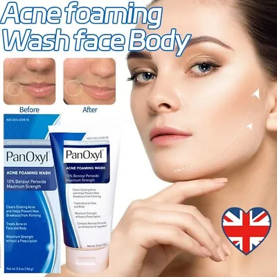 Acne Foaming Wash Face & Body 10% Active Ingredient 156g New UK 2024 • £8.09