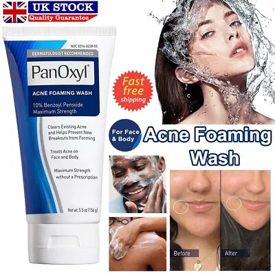 New Acne Foaming Wash Face & Body 156g Peroxide All Skin Types 5.5oz • £7.99