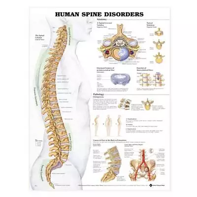 New Human Spine Disorders Anatomical Chart • $15.98