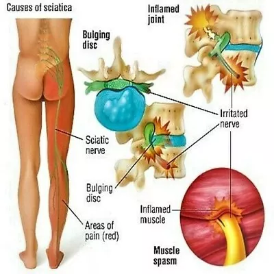 £24.99 • Buy Sciatica Pain Relief Cream Reduce Painful Nerve Inflammation Shooting Pain 