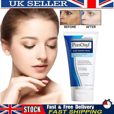 Acne Foaming Wash Face & Body 10% Active Ingredient 156g New UK Moisture • £8.59