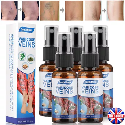 Varicose Veins Miracle Ointment Cream Gel Veinhealing Varicose Treatment Spray • £6.95