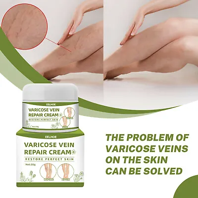 Spider Vein Varicose Natural Dead Sea Cream Remover Treatment For Legs Face Nose • £5.88