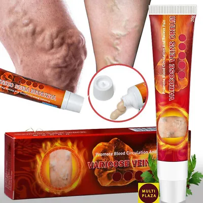 Herbal Varicose Veins Treatment Cream Ointment Leg Vasculitis Phlebitis Remove • $3.02