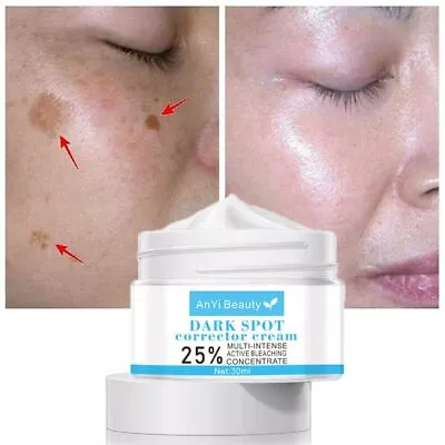 Remove Speckle Removal Melasma Whitening Cream Freckle Remover Cream For Face • £4.39