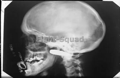 £5.15 • Buy WW2 Picture Photo X Ray Skull 0.50 Caliber Bullet Wound Below Right Eyebrow 3216