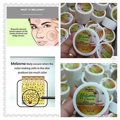 Melasma Cream Remove Dark Acne Sun Spot Melasma Hyperpigmentation Best Seller • $10