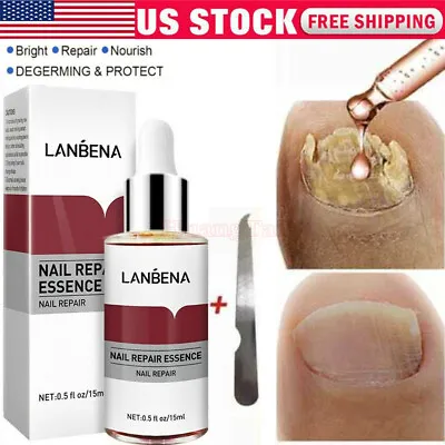 Nail Repair Serum Fungal Nail Treatment Liquid Remove Toe Nail Fungus Essence US • $9.28