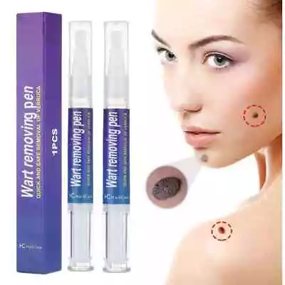 2 Pack Liquid Wart Remover Pen Natural Treatment Moles Skin Tag Safe Verruca • £7.95