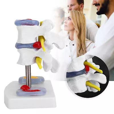 Anatomical Lumbar Disc Herniation Model Human Spine School Training Tool Supply • $17.29