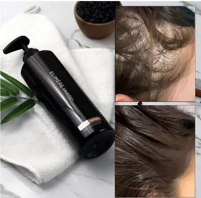 Savemo Hair Loss Shampoo Oily Shampoo Seborrheic Dermatitis 500ml For Hair Loss • £47.25