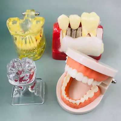  Dental Implant Analysis Typodont Sinus Upper Teeth Model Crown Bridge  • $7.35