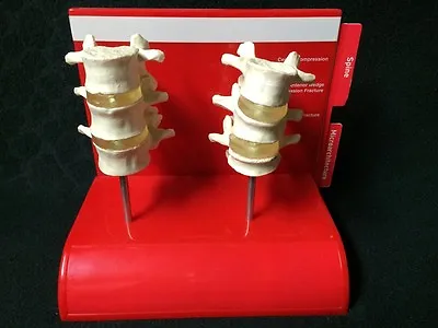Vintage Evista Spine Compression Fracture Anatomical Model Vertebrae Vertebral • $39.95
