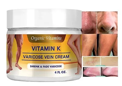 Vitamin K Cream Spider Varicose Veins Scars Rosacea Capillaries Dark Circles 4OZ • $13.98