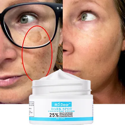 Skin Whitening Lightening Brightening For Dark Spot And Melasma Remover Cream • £7.45