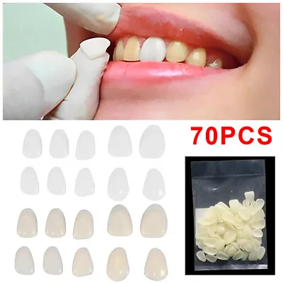 70x Dental Teeth Veneers Thin Whitening Resin Anterior Upper Temporary Crown US • $8.69