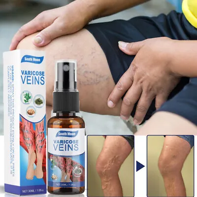 Vein Healing Varicose Veins Treatment Spray Anti Swelling Spider Leg/Massage Oil • $7.25