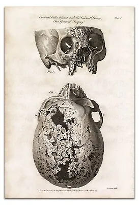 Anatomy SKULLS INFECTED WITH THE VENEREAL DISEASE (PLATE 1) Vintage 22x15  Print • $20.99