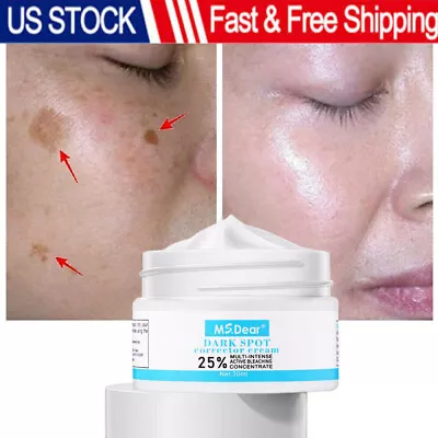 $8.95 • Buy Strong Removal Melasma Whitening Cream Freckle Speckle Sunburn Spots Pigment