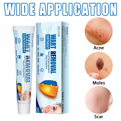 Skin Tag Removal Warts Remover Cream Herbal Ointment Face Body Tag Remover 20g • £3.77