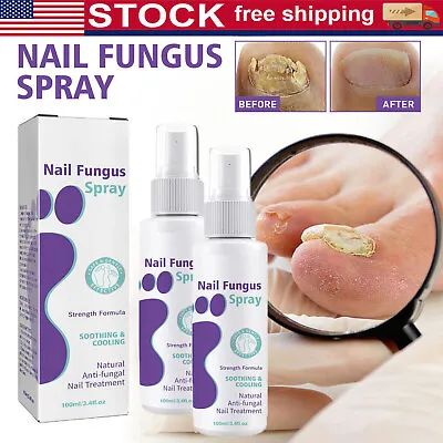 2Pack 100ML Medinail Fungus SprayToenail Fungus TreatmentNail Fungus Treatment • $12.95