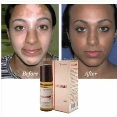 Melgain Lotion For Vitiligo White Spots Patches 5ml + Free Shipping • $24.22