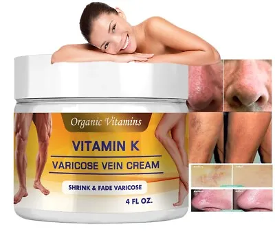 Varicose Cream Natural Vein Leg Support Spider Vitamin K • $12.96