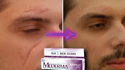 Mederma Advanced Plus Scar Gel 5g FREE & FAST SHIPPING • $12.34