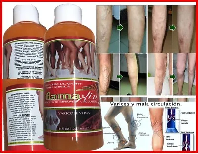  Herbal Ointment Varicose Veins Vasculitis Support Foot Care Cream Leg Gel Cream • $12.50