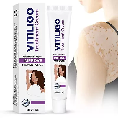 Crema Tratamiento De Vitiligo Para Reducir Y Decolorar Manchas Blancas Del Piel • $38.99