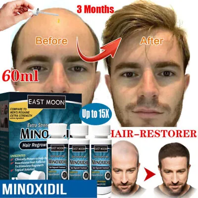 £35.95 • Buy 15X Hair Regrowth 5% Extra Strength Topical Hair Loss Treatment For Men Solution